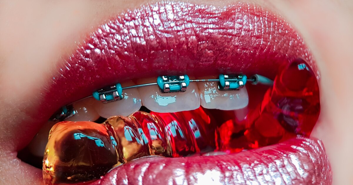 They Scratch Enamel and “Ring” at the Airport: 6 Brace Myths It’s Time to Stop Believing