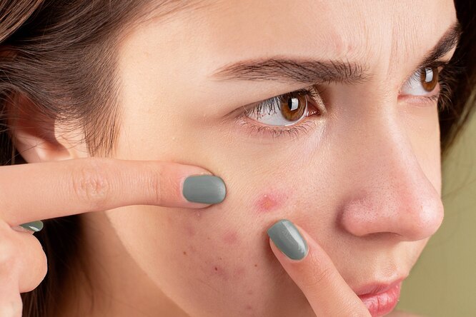 Высыпания на лице: главные причины появления прыщей на разных участках кожи