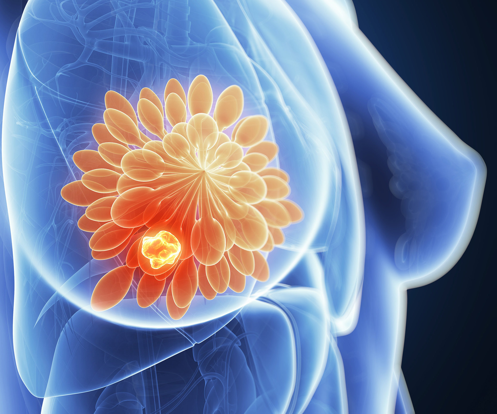 7 признаков рака груди, о которых знают не все