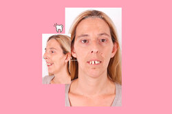 Женщина всю жизнь считала себя уродиной, пока не исправила зубы — фото до/после