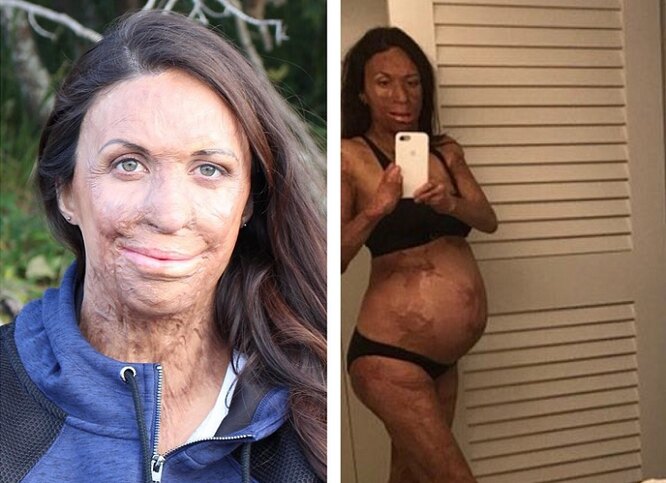 30-летняя модель Турия Питт, обгоревшая при пожаре, показала беременный животик