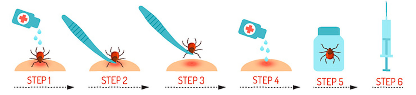 Как удалить клеща у человека самостоятельно. Алгоритм удаления клеща. Алгоритм извлечения клеща.