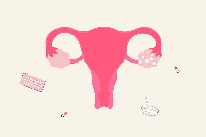8 early signs of ovarian cancer, from the most obvious to the most subtle