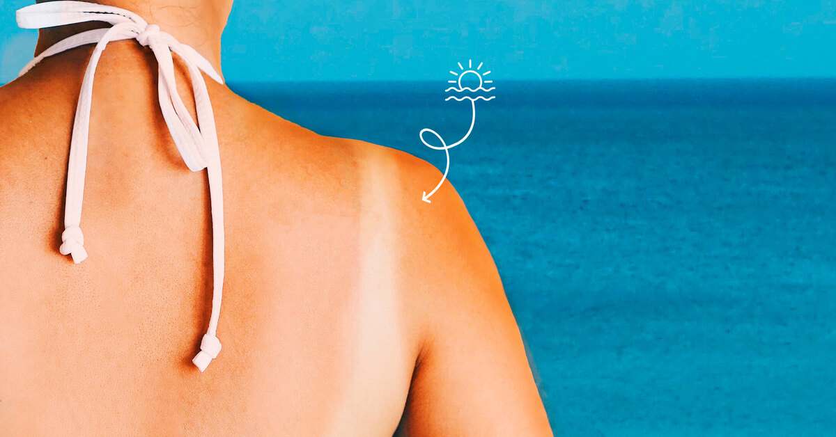 Zebra tan: 3 ways to even out skin tone if you have burnt parts of your body