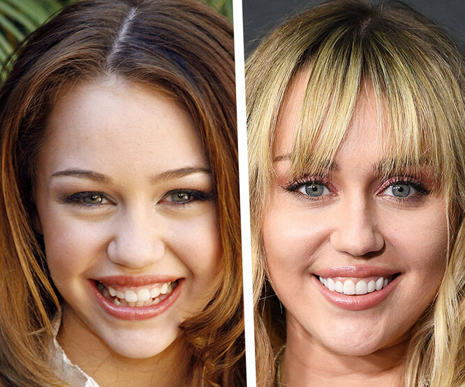 До и после виниров: как «новые зубы» преобразили знаменитостей — 10 примеров