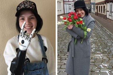 Девушка, которой муж отрубил кисти рук из ревности, поставила протез в Германии